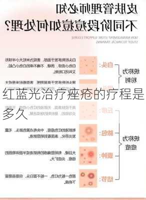 红蓝光治疗痤疮的疗程是多久
