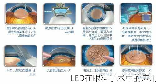 LED在眼科手术中的应用