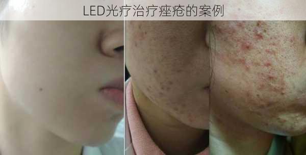 LED光疗治疗痤疮的案例