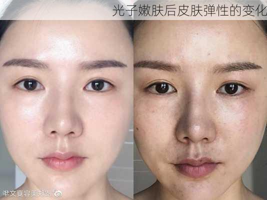 光子嫩肤后皮肤弹性的变化