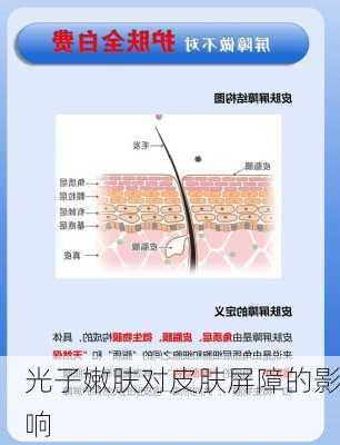 光子嫩肤对皮肤屏障的影响
