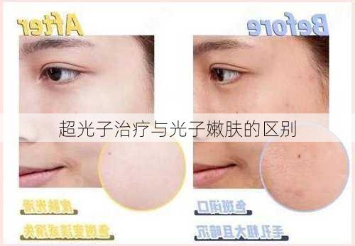 超光子治疗与光子嫩肤的区别