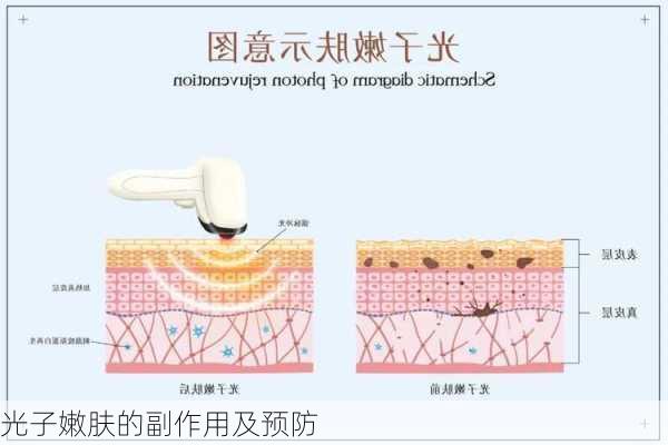 光子嫩肤的副作用及预防