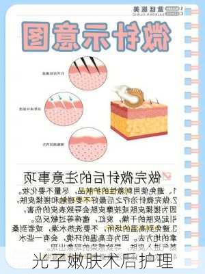 光子嫩肤术后护理