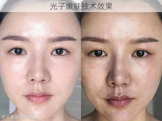 光子嫩肤技术效果
