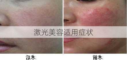 激光美容适用症状