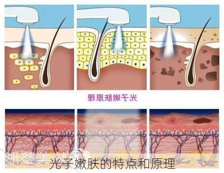 光子嫩肤的特点和原理