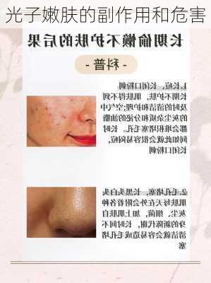 光子嫩肤的副作用和危害