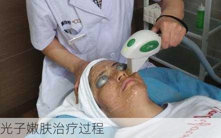 光子嫩肤治疗过程