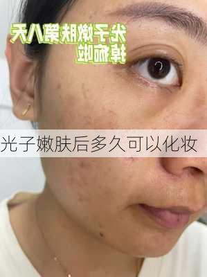 光子嫩肤后多久可以化妆