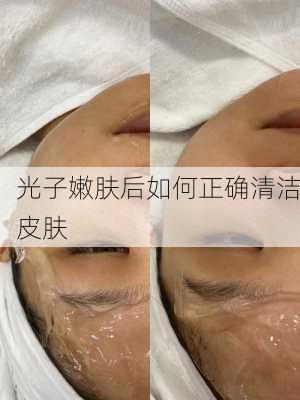 光子嫩肤后如何正确清洁皮肤