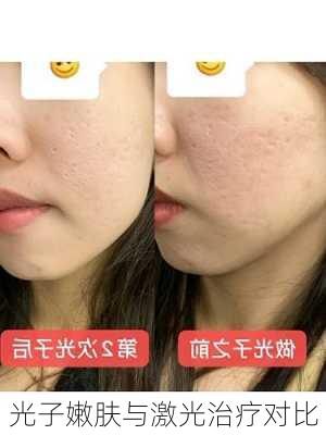 光子嫩肤与激光治疗对比