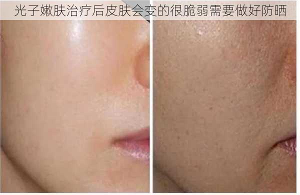 光子嫩肤治疗后皮肤会变的很脆弱需要做好防晒