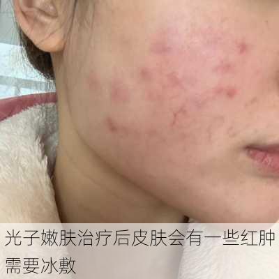 光子嫩肤治疗后皮肤会有一些红肿需要冰敷