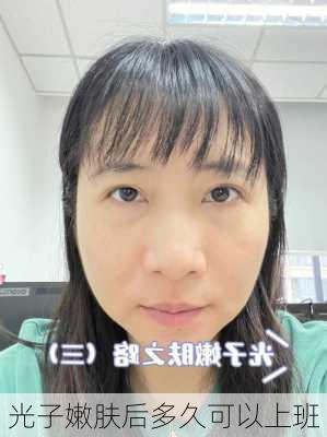 光子嫩肤后多久可以上班