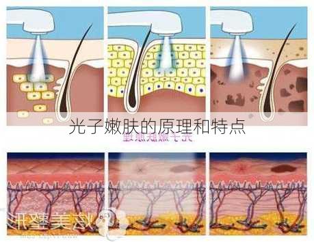 光子嫩肤的原理和特点