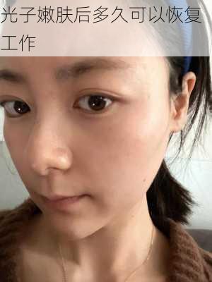 光子嫩肤后多久可以恢复工作