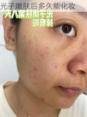 光子嫩肤后多久能化妆