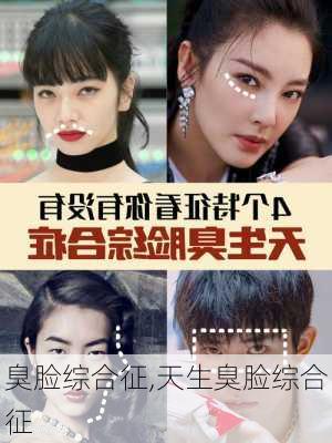 臭脸综合征,天生臭脸综合征
